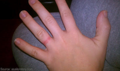 Help! I'm allergic to my ring!